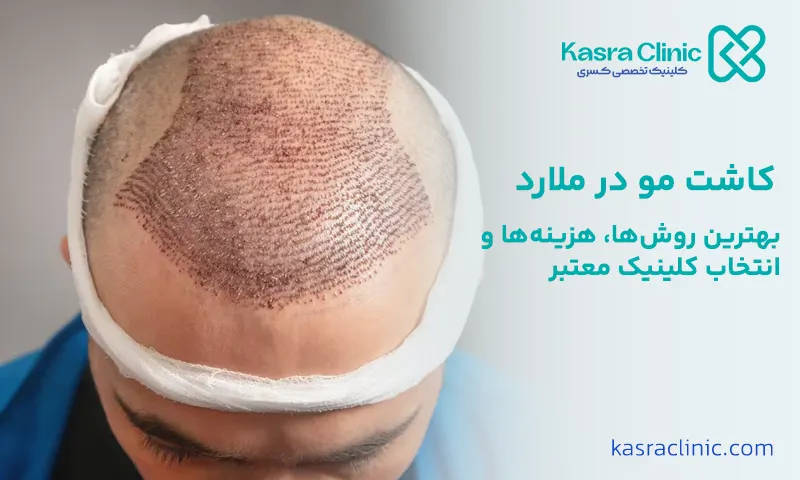 کاشت مو در ملارد